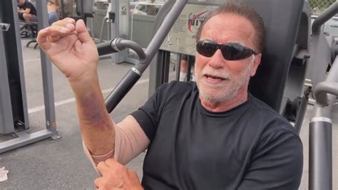 arnold schwarzenegger mildly injured